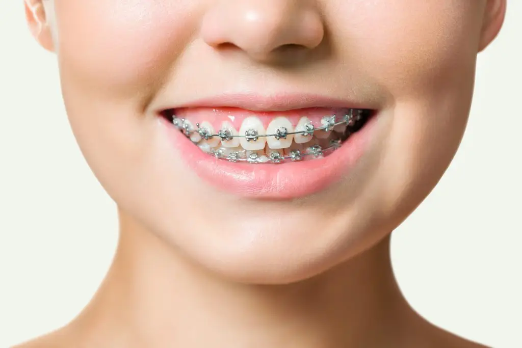 Orthodontic,Treatment.,Dental,Care,Concept.,Beautiful,Woman,Healthy,Smile,Close